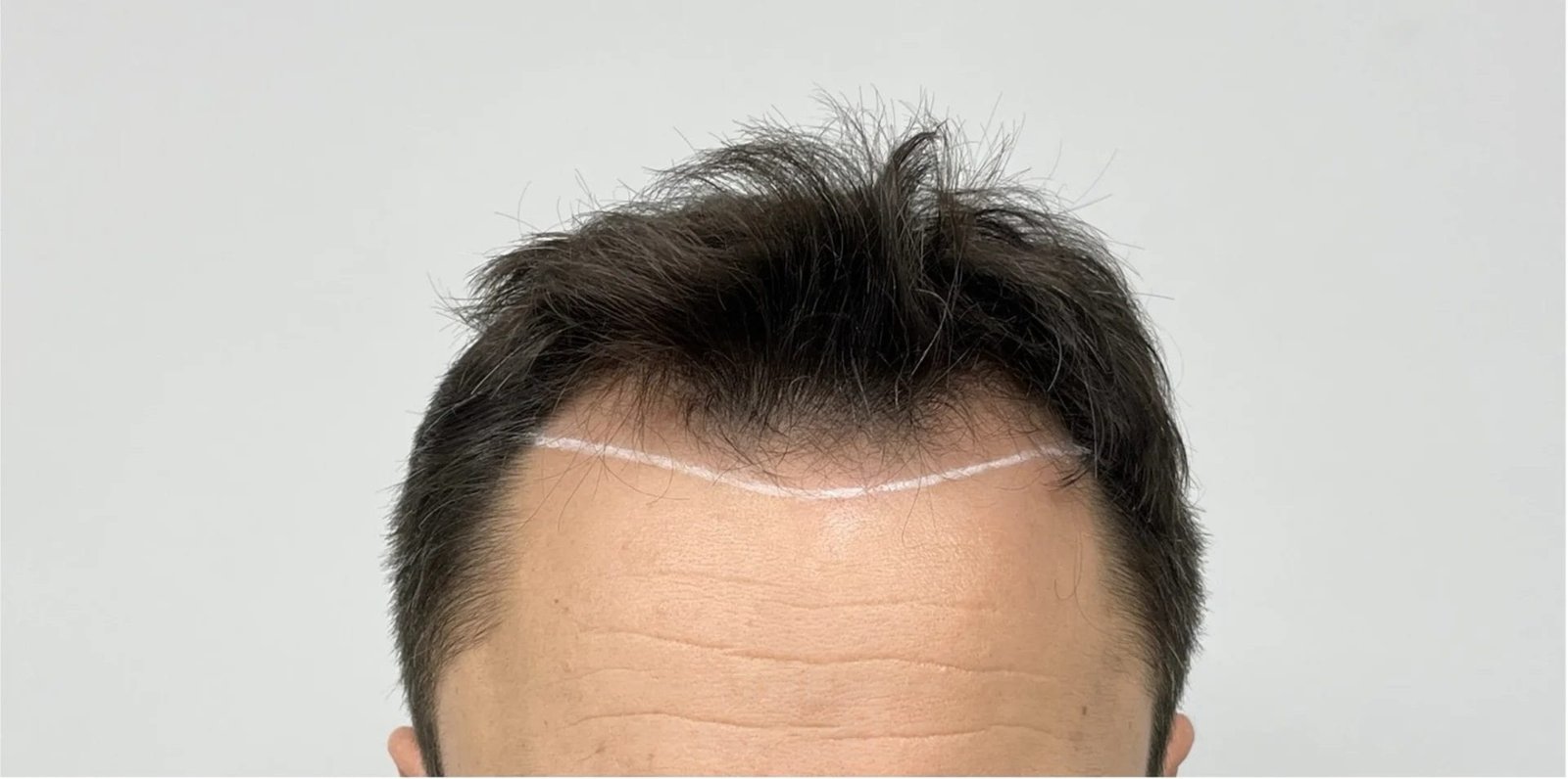 Πριν τη μεταμόσχευση